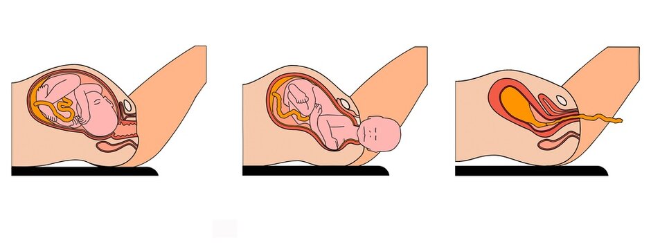 The Three Stages of Childbirth and Placental Delivery