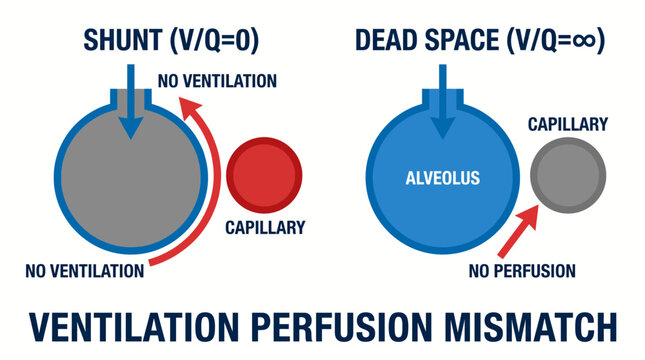 Ventilation Perfusion Mismatch Shunt and Dead Space Diagram