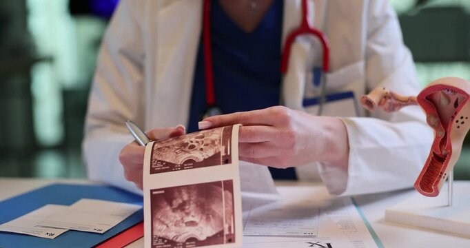Gynecologist holds ultrasound images near uterus anatomical model on table in clinic office. Doctor studies patient ultrasonic scans in hospital
