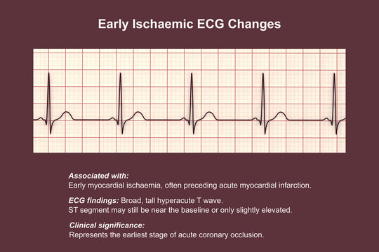 Electrocardiogram showing hyperacute T waves, 3D illustration of ECG trace indicating early acute myocardial ischemia with tall symmetrical T waves.