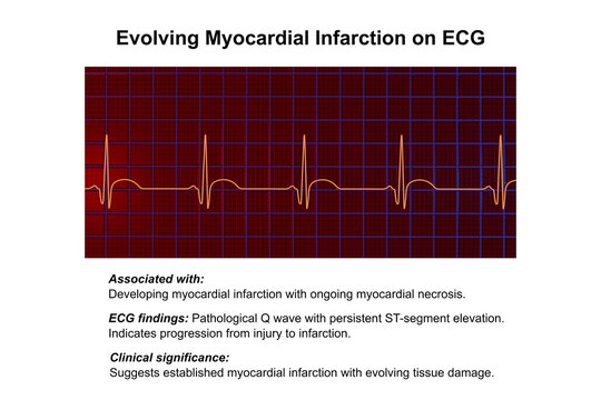 Electrocardiogram showing pathological Q wave with ST-segment elevation, 3D illustration of ECG trace indicating acute myocardial infarction.