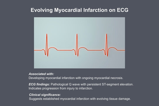 Electrocardiogram showing pathological Q wave with ST-segment elevation, 3D illustration of ECG trace indicating acute myocardial infarction.