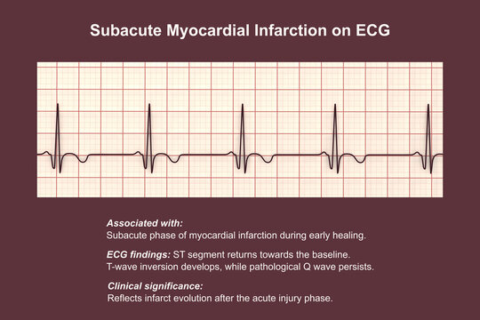 Subacute stage of myocardial infarction, 3D