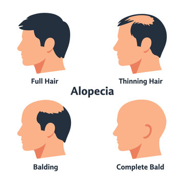 Male hair loss progression stages, illustrating the journey from full hair to thinning, balding, and complete baldness in men