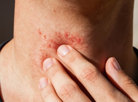 Person touches red itchy bumps on neck showing skin irritation or allergic reaction. Close up of skin issue in natural bright light, discomfort visible.