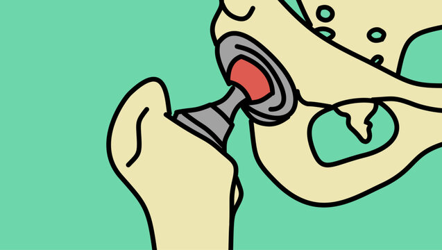 Total hip replacement, color vector illustration