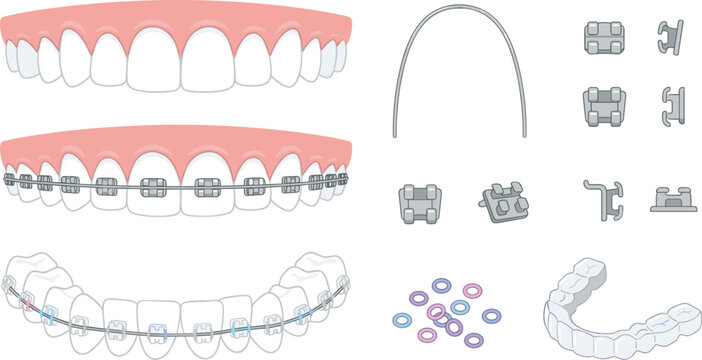 Orthodontic braces treatment set with dental brackets archwire elastic ligatures retainers and teeth alignment correction illustration