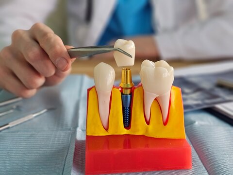 Demonstration of dental implant placement using a model in a dental