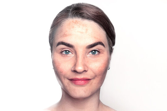 Close-up face of attractive woman with dark spot on her face skin, hyperpigmentation melasma hormonal changes or freckles spots caused by genetics or exposure to the sun on white background