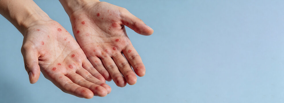 Child hands with red measles rash on palms. Infected skin with spots and blisters. Close up of viral exanthema symptoms for medical research and healthcare awareness about vaccination.