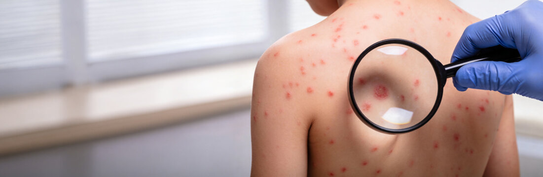 Pediatrician examining skin rash on back of child with magnifying glass. Doctor diagnosing measles or viral infection symptoms. Medical consultation and healthcare concept.