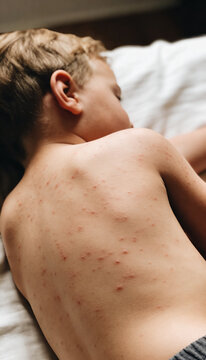 Child with measles lying on bed. Boy suffering from skin rash and viral infection. Symptom of contagious disease. Medical healthcare concept for vaccination and pediatric immunity support.