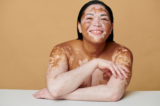 Happy woman with unique skin