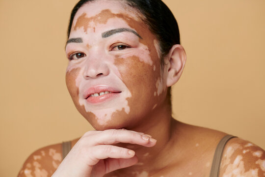 woman with unique skin - Vitiligo