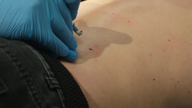 Modern laser coagulation tool usage in skin neoplasm treatment in clinic slow motion. Doctor removes mole from patient back in hospital closeup