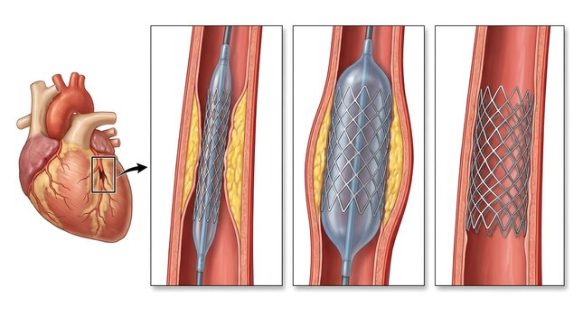 Medical illustration showing coronary artery stent procedure with balloon angioplasty steps inside a human heart for cardiovascular health