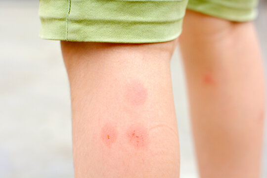 Spider bites on the leg.