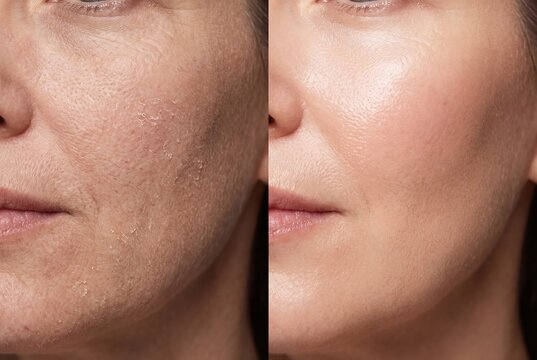 Split image showing dramatic skin transformation from dry, flaky texture to smooth, hydrated, and radiant complexion.