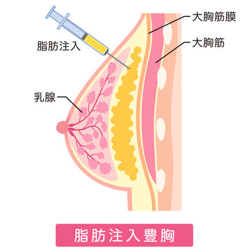 脂肪注入をした胸　豊胸手術の構造　脂肪豊胸