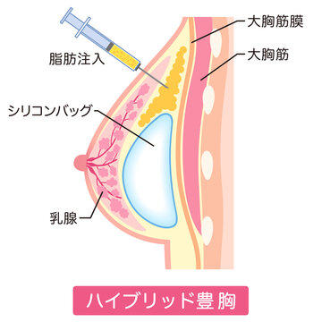 ハイブリッド豊胸　豊胸手術の種類　美容整形　胸