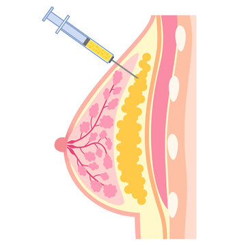 脂肪注入をした胸　豊胸手術の構造　脂肪豊胸