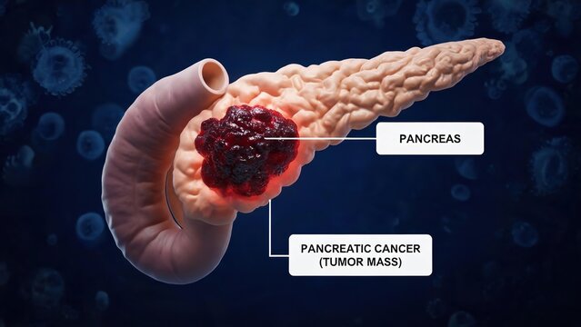 3D Medical Illustration of Pancreatic Cancer, Showing a Malignant Tumor Mass on the Human Pancreas