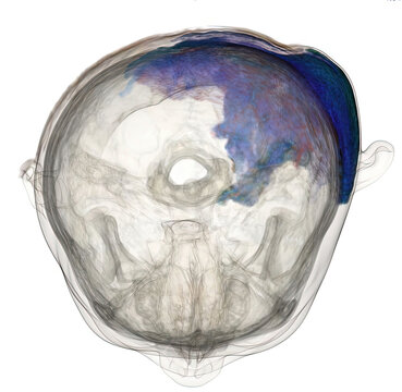 3D CT shows extensive left mastoid abscess extending to temporal lobe, cerebellum, scalp, and deep neck spaces. Derived from real CT imaging data, not AI-generated