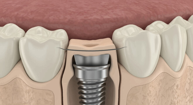 Medical illustration of a dental implant procedure showcasing the structural integration of a prosthetic tooth replacement within the jawbone