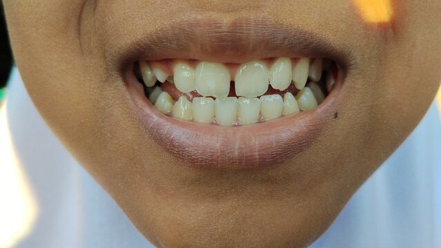 Front view macro closeup of human teeth with middle incisor gap