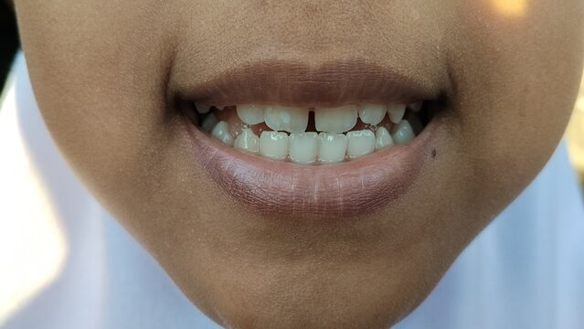 Close up of human mouth with diastema gap teeth problem