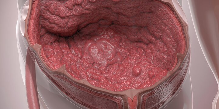 3d medical of human urinary bladder interior showing inflamed tissue and pathological condition details