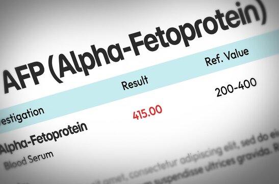 Afp blood test analysis elevated alpha-fetoprotein level, test result report with values typography, illustration