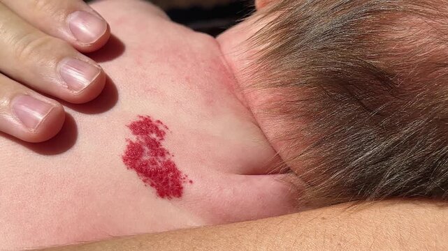 Nevus of the unna in the form of a heart on the back of a newborn baby. A birthmark is a heart on the baby's skin. Angel's Kiss. Medicine and Children's Health