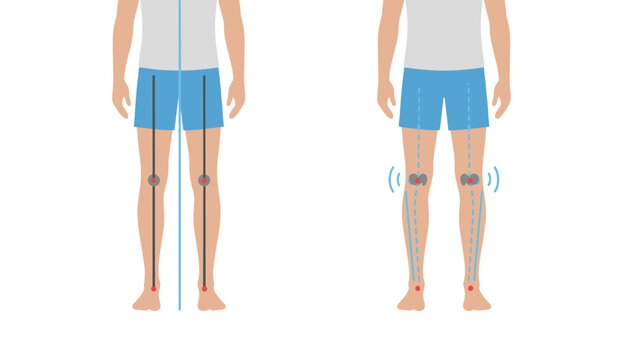 Medical diagram illustrates the difference between normal leg alignment and bowed legs to show skeletal variations and potential health issues.