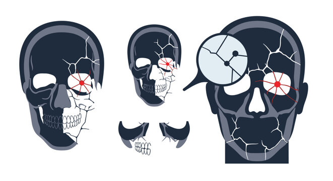 Multiple illustrations of human skulls showing different types of bone fractures and trauma for forensic or medical study and diagnostics.