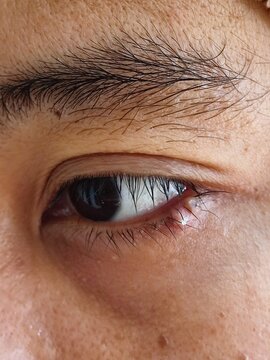 A macro, close-up shot of a human eye showing a small, clear, dome-shaped cyst or nodule on the lower eyelid margin near the eyelashes, resembling an eyelid hydrocystoma or milia.