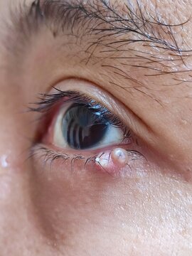 anatomy, benign, brow, bump, chalazion, close-up, condition, cornea, cyst, dermatology, detail, diagnostic, eye, eyelashes, eyelid, fluid, gland, growth, health, healthcare, hidrocystoma, hordeolum, h
