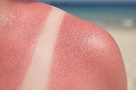 Woman shoulder with skin tan line and red sunburn from sun exposure. Skin damage and pain caused by excessive ultraviolet radiation. Dermatology health care and summer safety concept.