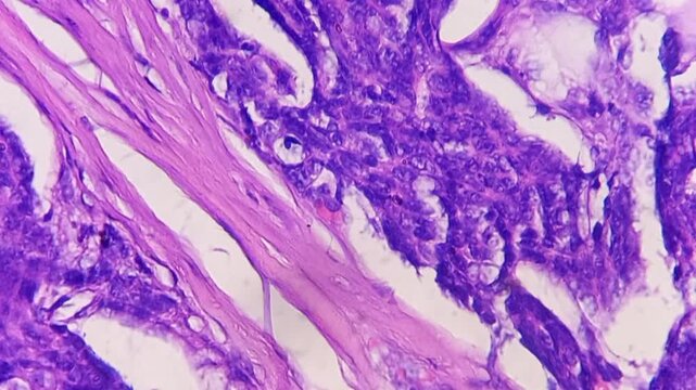 Histopathology of right breast lump. Infiltrating ductal carcinoma (nst), well differentiated G-1. Section of breast tumour reveal features of an infiltrating ductal carcinoma. 