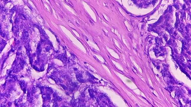 Histopathology of right breast lump. Infiltrating ductal carcinoma (nst), well differentiated G-1. Section of breast tumour reveal features of an infiltrating ductal carcinoma. 