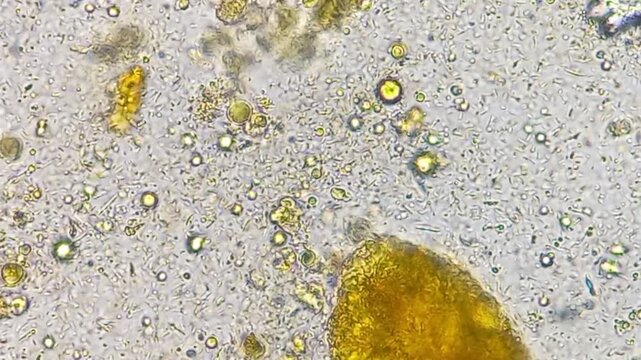 Microscopic footage of human feces or stool showing epithelial cells, pus cells, fat globules, Vegetable cells and bacteria.