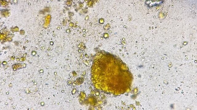 Microscopic footage of human feces or stool showing epithelial cells, pus cells, fat globules, Vegetable cells and bacteria.