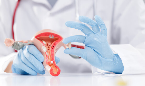 Gynecologist holding vitamins pill and suppositories to restore microflora of uterine model