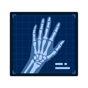 Detailed X ray illustration showing the intricate skeletal structure of a human hand and wrist.