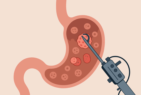 Medical procedure illustration showing an endoscope removing polyps or tumors from the interior of a human stomach.