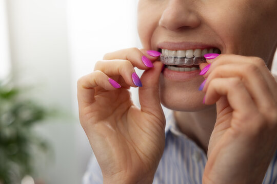 woman inserting transparent invisible dental aligners for teeth straightening, night guard