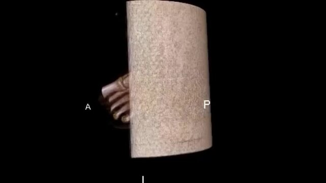 3D CT Scan Rotation of Right Ankle Joint Showing Distal Tibia Fibula and Tarsal Bone Anatomy