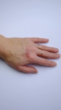 Burn on a woman hand. Selective focus.