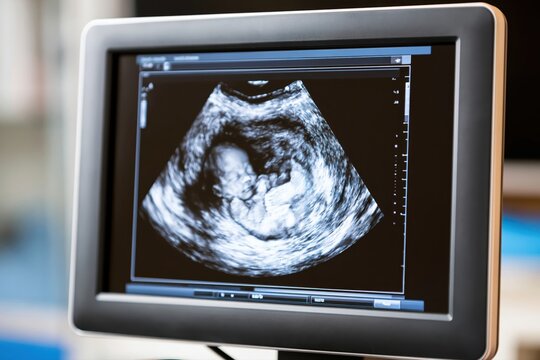 Close-up of a medical ultrasound screen displaying a detailed fetal sonogram image of a developing baby.