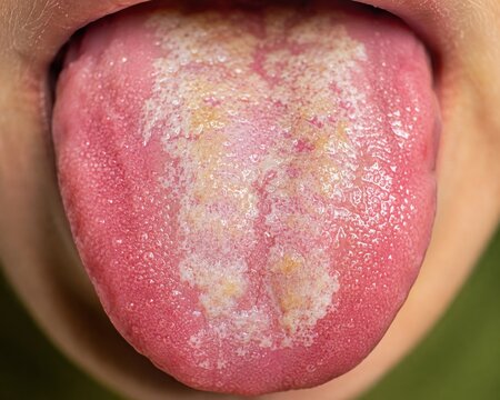 Human tongue showing symptoms of oral thrush with white fungal coating on surface tissue.